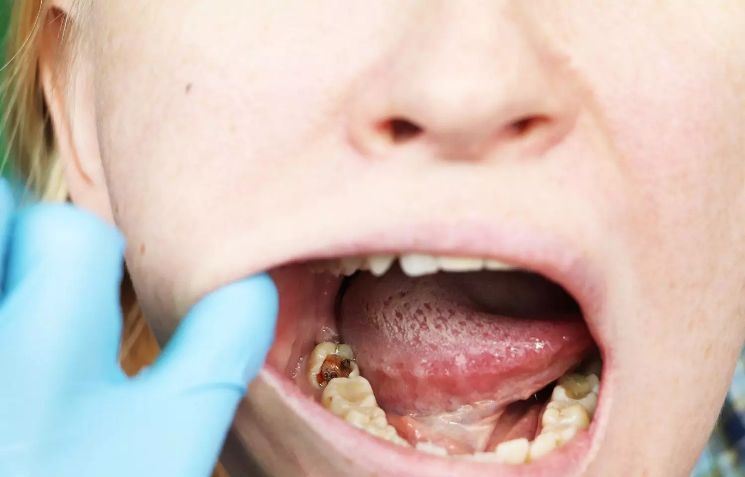 Superorganisms formed by bacterial and fungal partnership can colonise teeth and  cause cavities