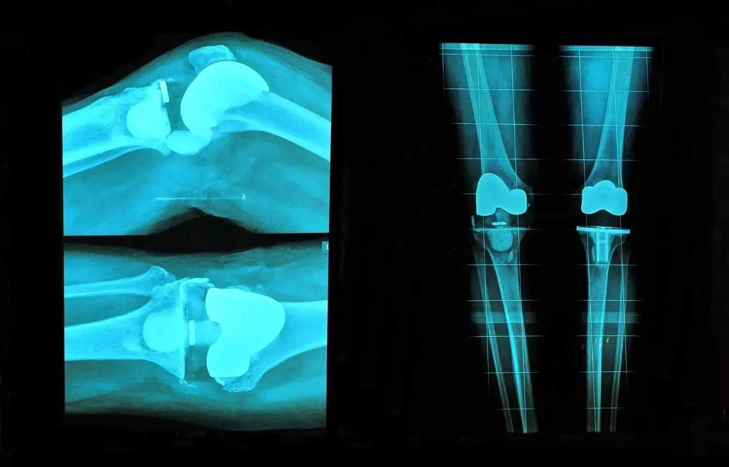 Cementless total knee arthroplasty tied to excellent biologic fixation reveals multispectral MRI