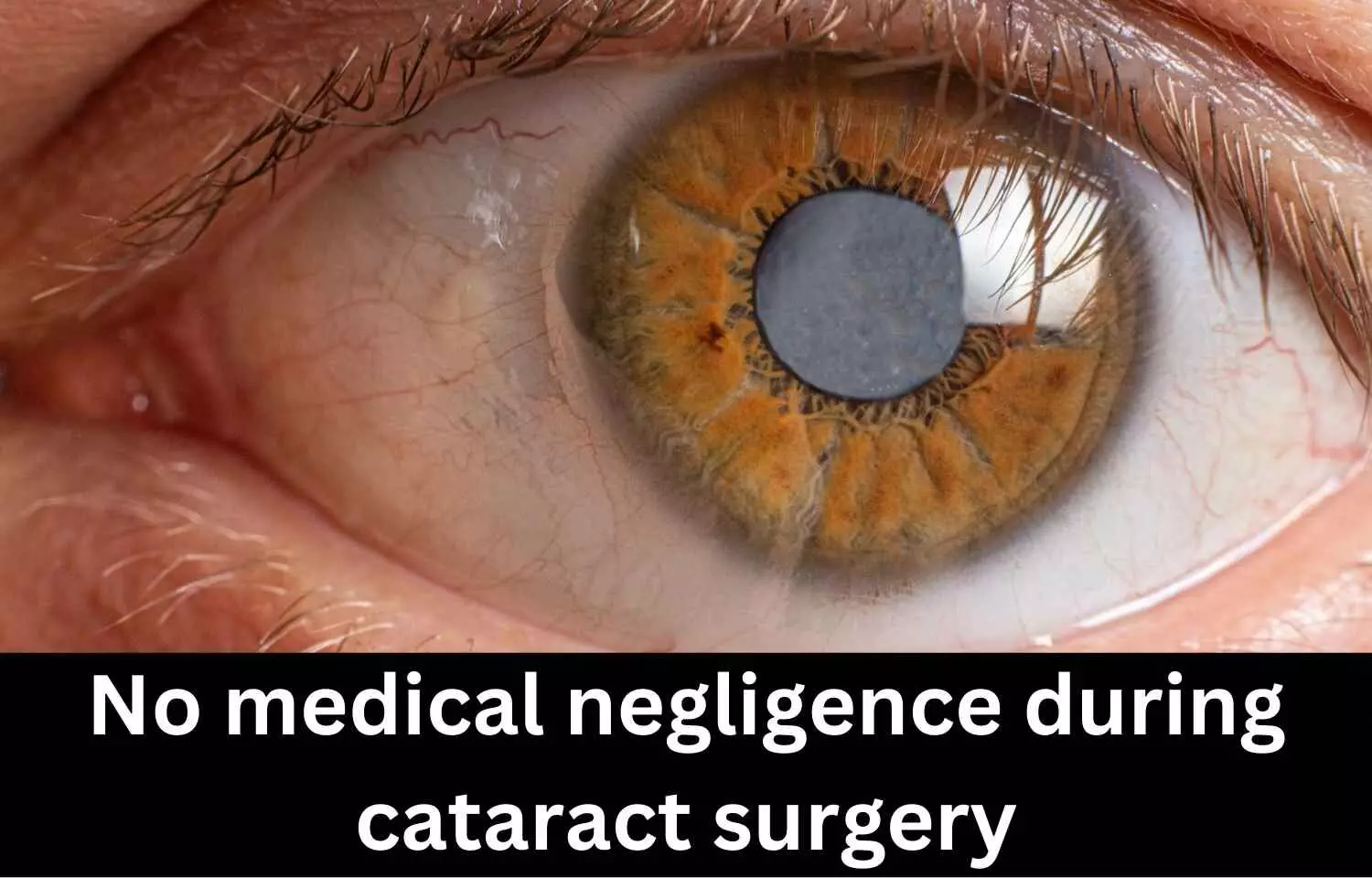 NCDRC exonerates Ophthalmologist, Eye Hospital from charges of medical negligence during cataract surgery