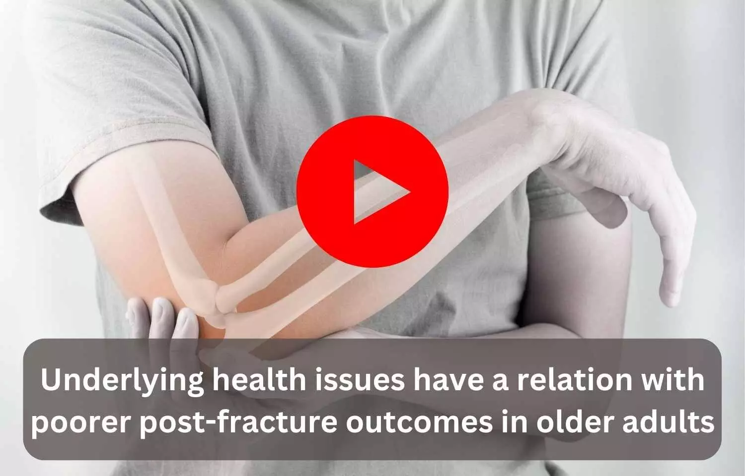 Underlying health issues have a relation with poorer post-fracture outcomes in older adults