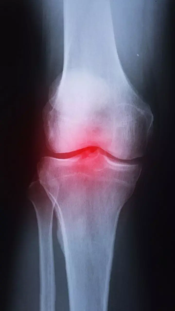 World Arthritis Day 2022