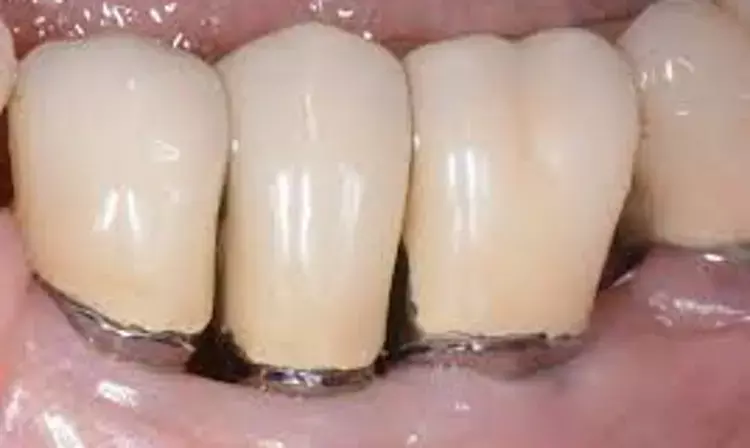 Periodontitis linked with reduced alveolar bone thickness and density
