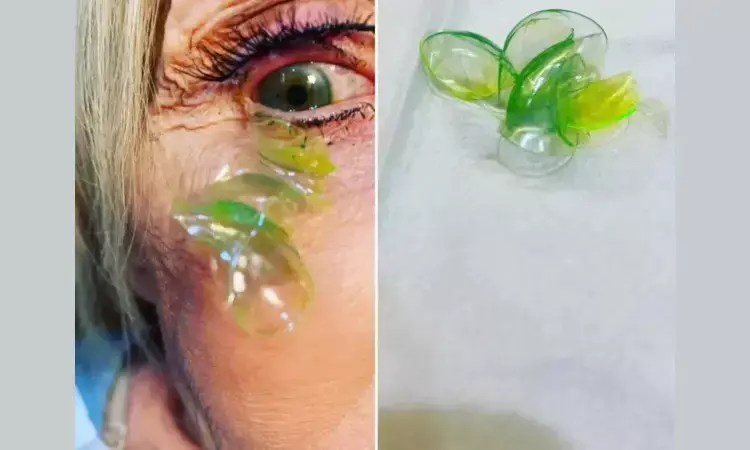 Viral video: California-based Ophthalmologist removes 23 contact lenses from womans eye