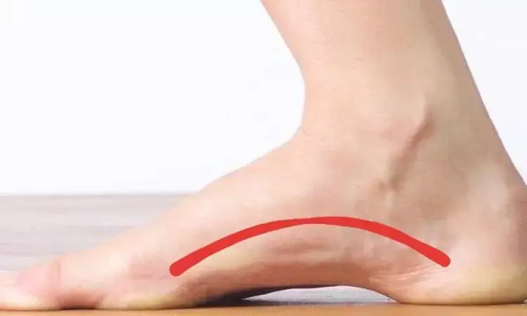 Foot Orthoses significantly reduces pain in adults with flexible flatfoot