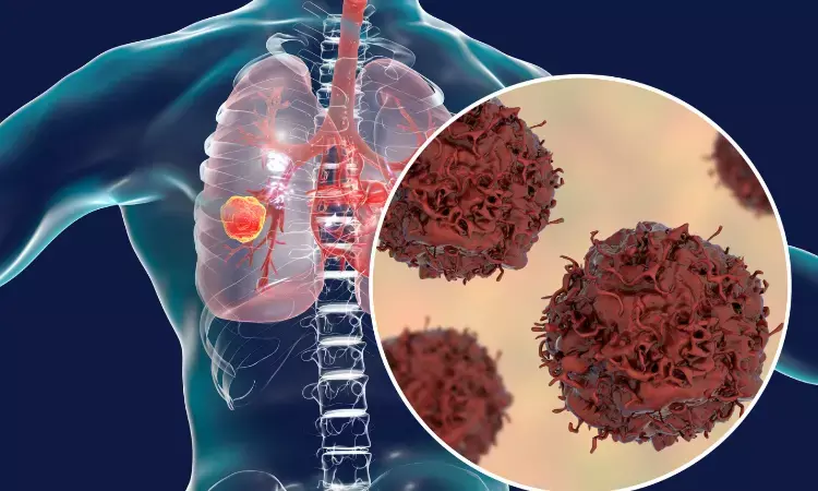 Combination immunotherapy before surgery promising for patients with non-small-cell lung cancer