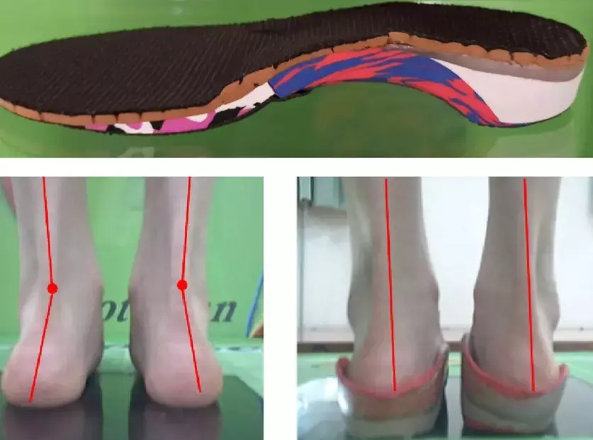 Pediatric symptomatic flexible flatfoot could be relieved by wearing insoles for 2 years