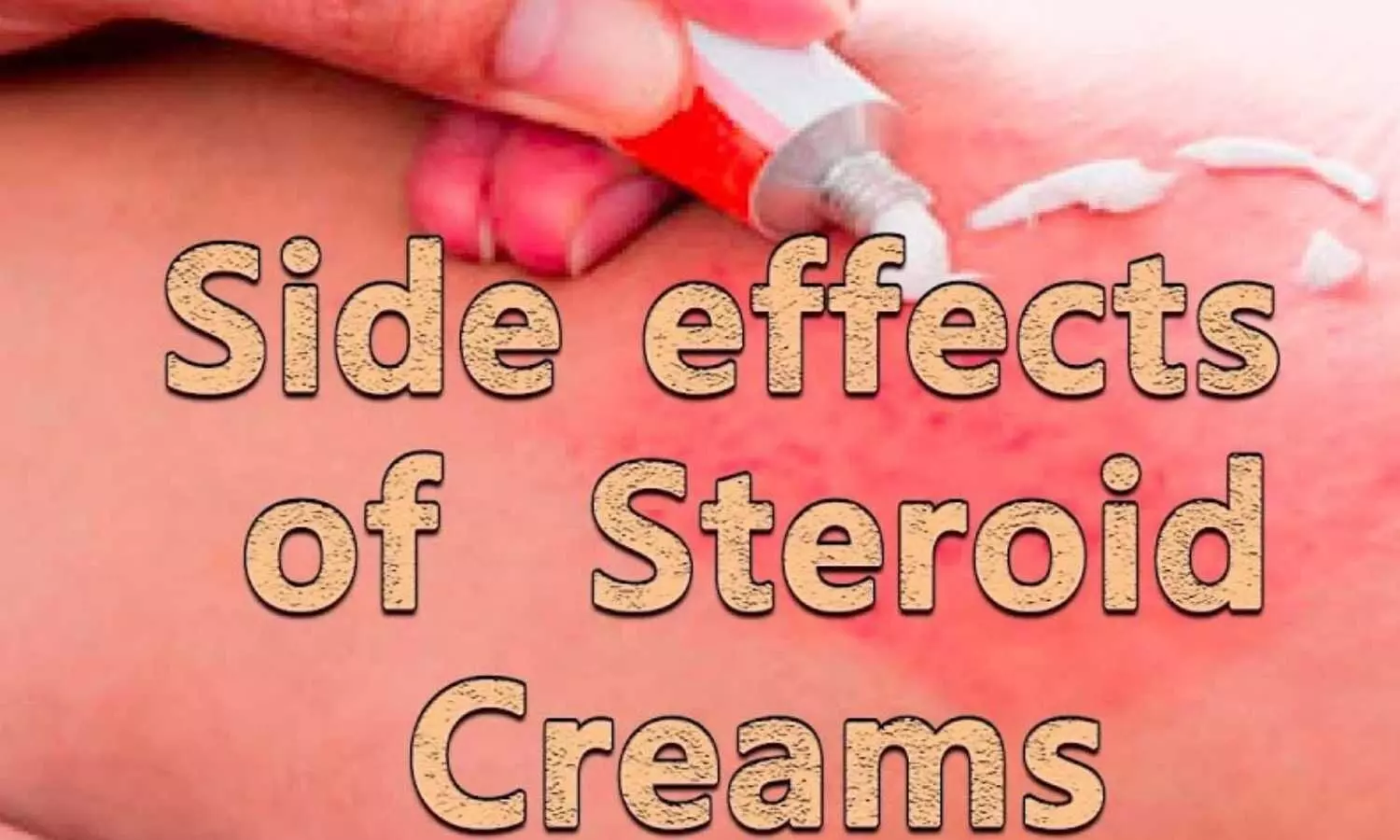 Side effects of Steroid Creams- Ft. Dr Bhawuk Dhir, MD Dermatology, RML Hospital, Delhi