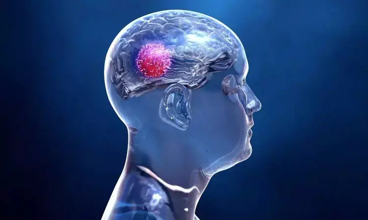 Losartan may prevent immunotherapy-induced brain swelling in patients with glioblastoma