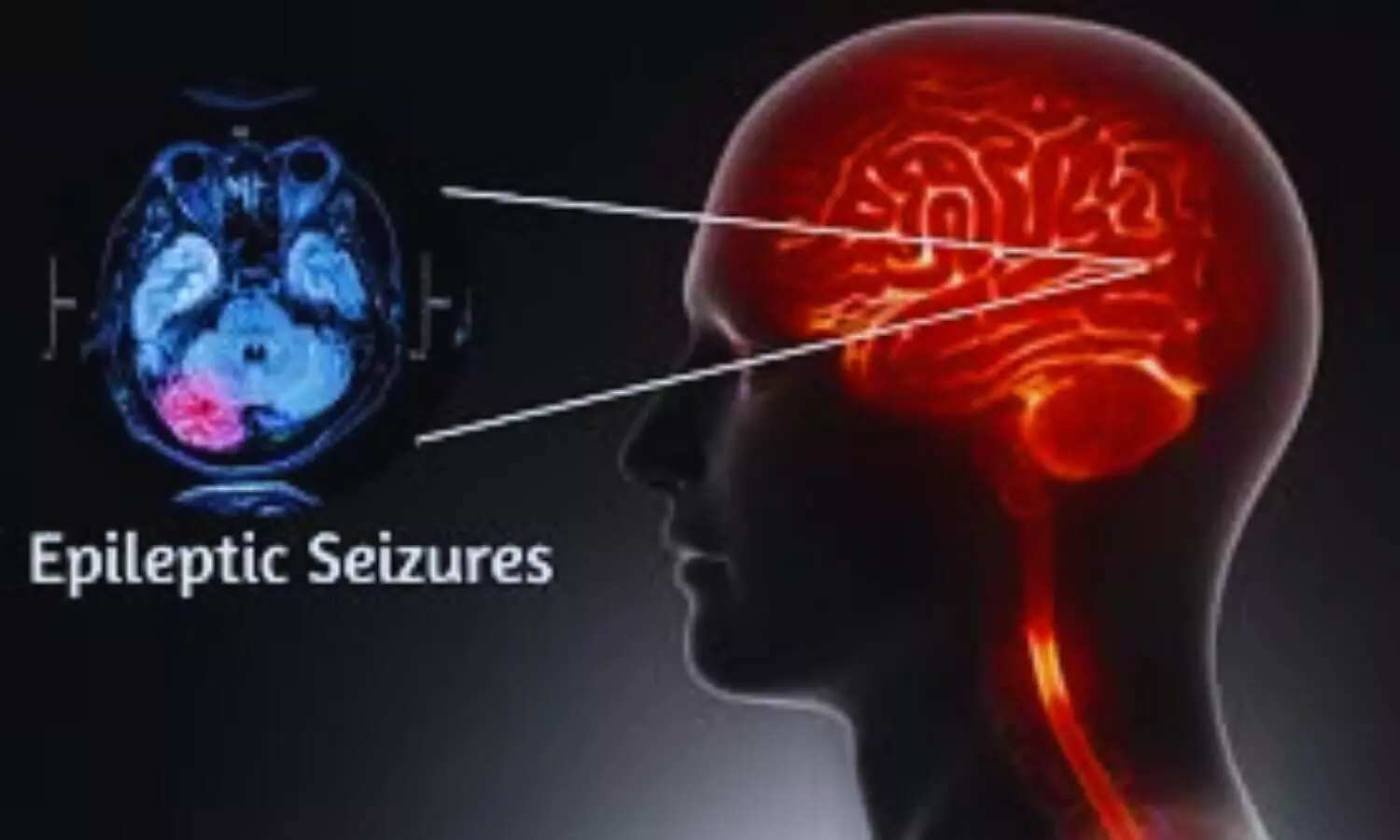 Treatments for patients with refractory Epilepsy: Guideline update
