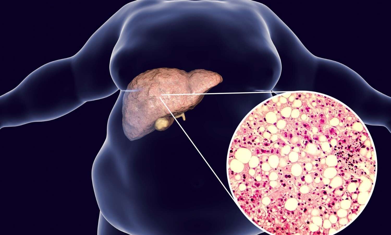 first-degree-relatives-of-patients-with-nafld-at-risk-of-developing