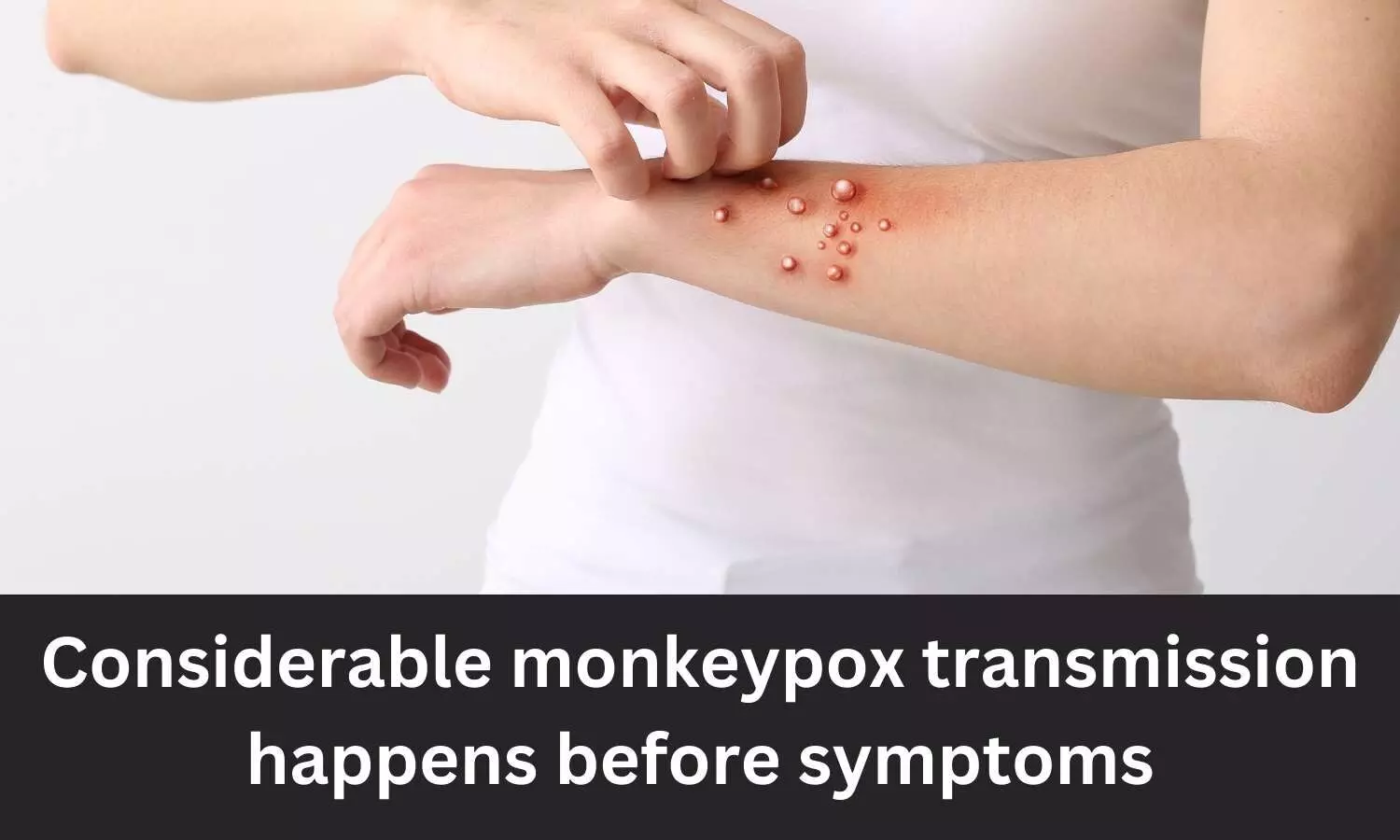 Considerable monkeypox transmission happens before symptoms: Study