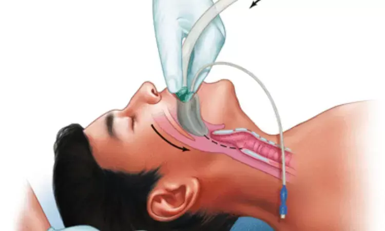 Laryngeal mask airway use tied to less pharyngolaryngeal complications after thyroid surgery
