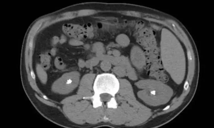 CT or ultrasound, which is better for kidney stone diagnosis? Study provides insights