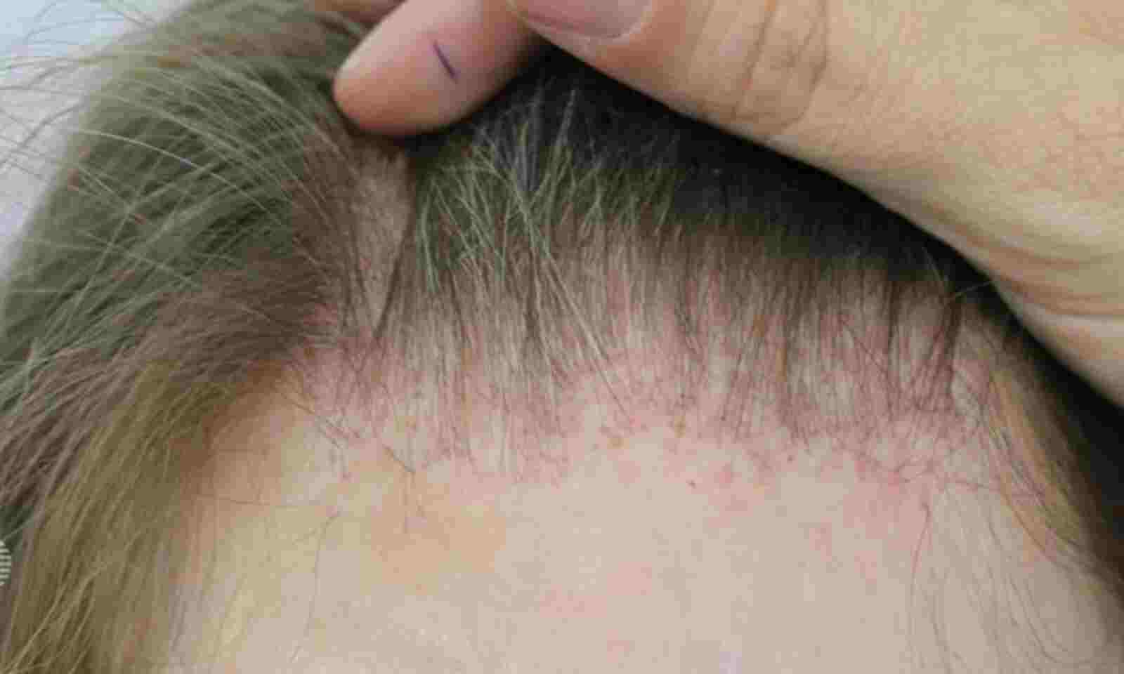 Pioglitazone reverses hair loss in patient with cicatricial alopecia: Case  report
