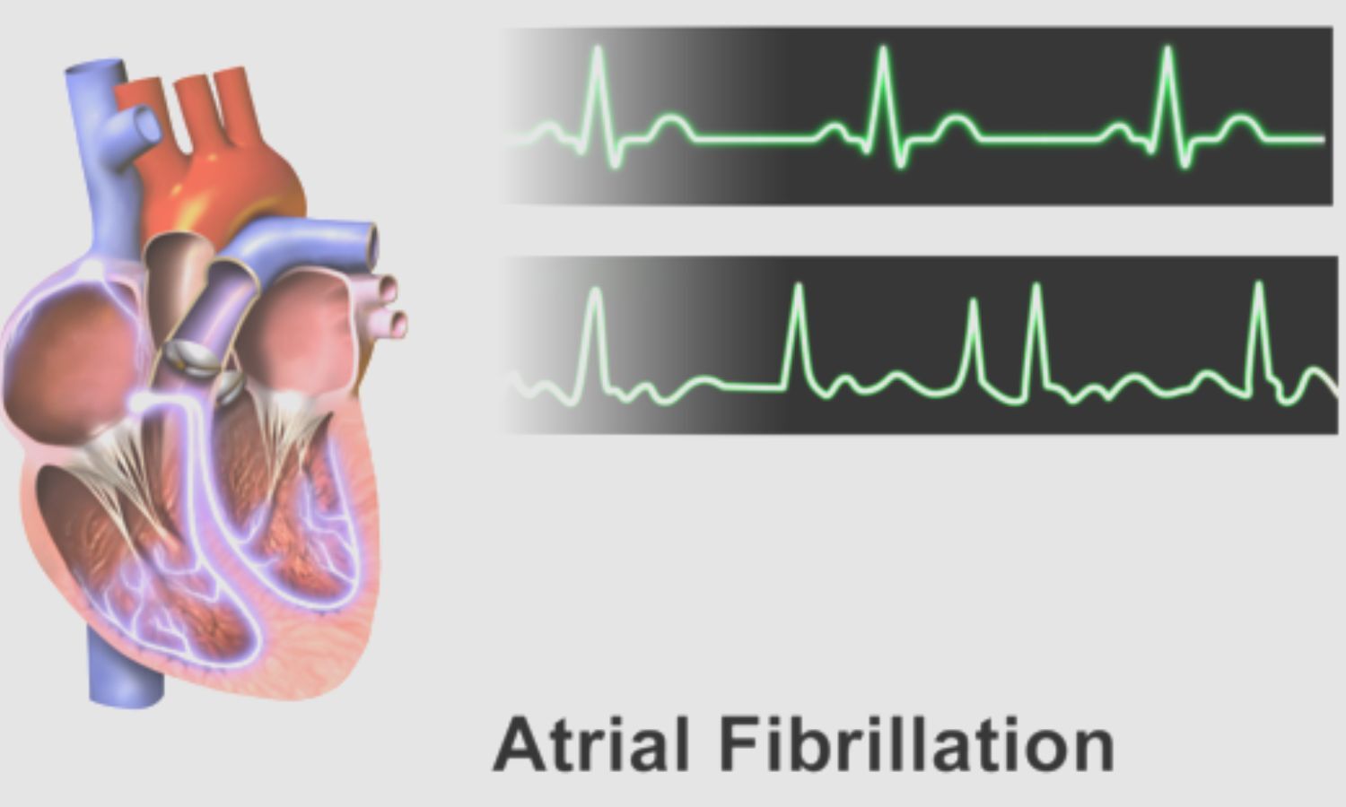 Iv Sotalol Loading Safe And Feasible In Adult Patients With Atrial 