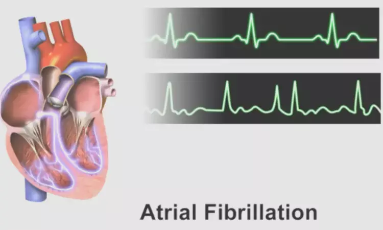 Atrial fibrillation associated with increased risk of memory decline and dementia