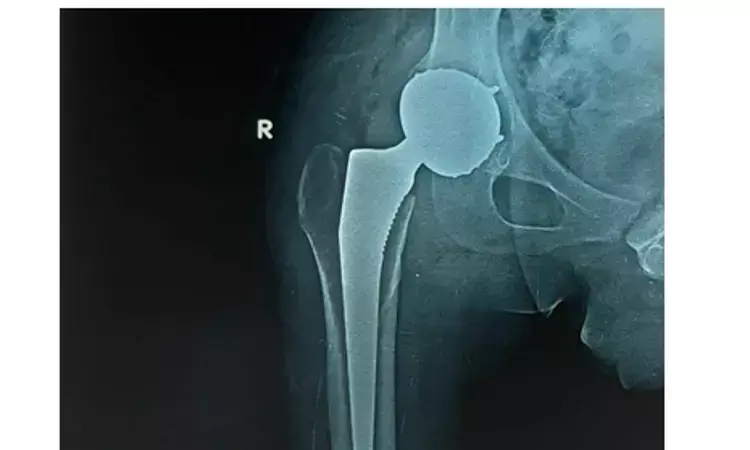 Single-stage Revision not superior to two-stage revision for Prosthetic hip Joint Infection: BMJ