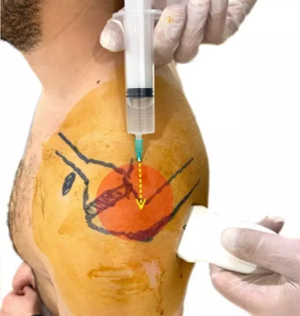 Usg Guided Multisite Injection Technique For Nonsurgical Treatment Of Frozen Shoulder Serves