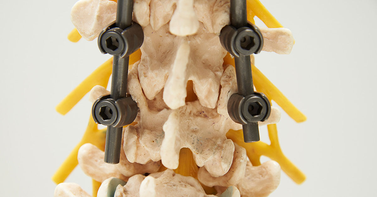 Ctnav Technique Increases Accuracy Of Pedicle Screw Placement Compared With Fluoroscopy 