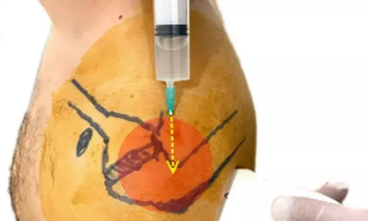 USG guided multisite injection technique for nonsurgical treatment of Frozen Shoulder serves better analgesia