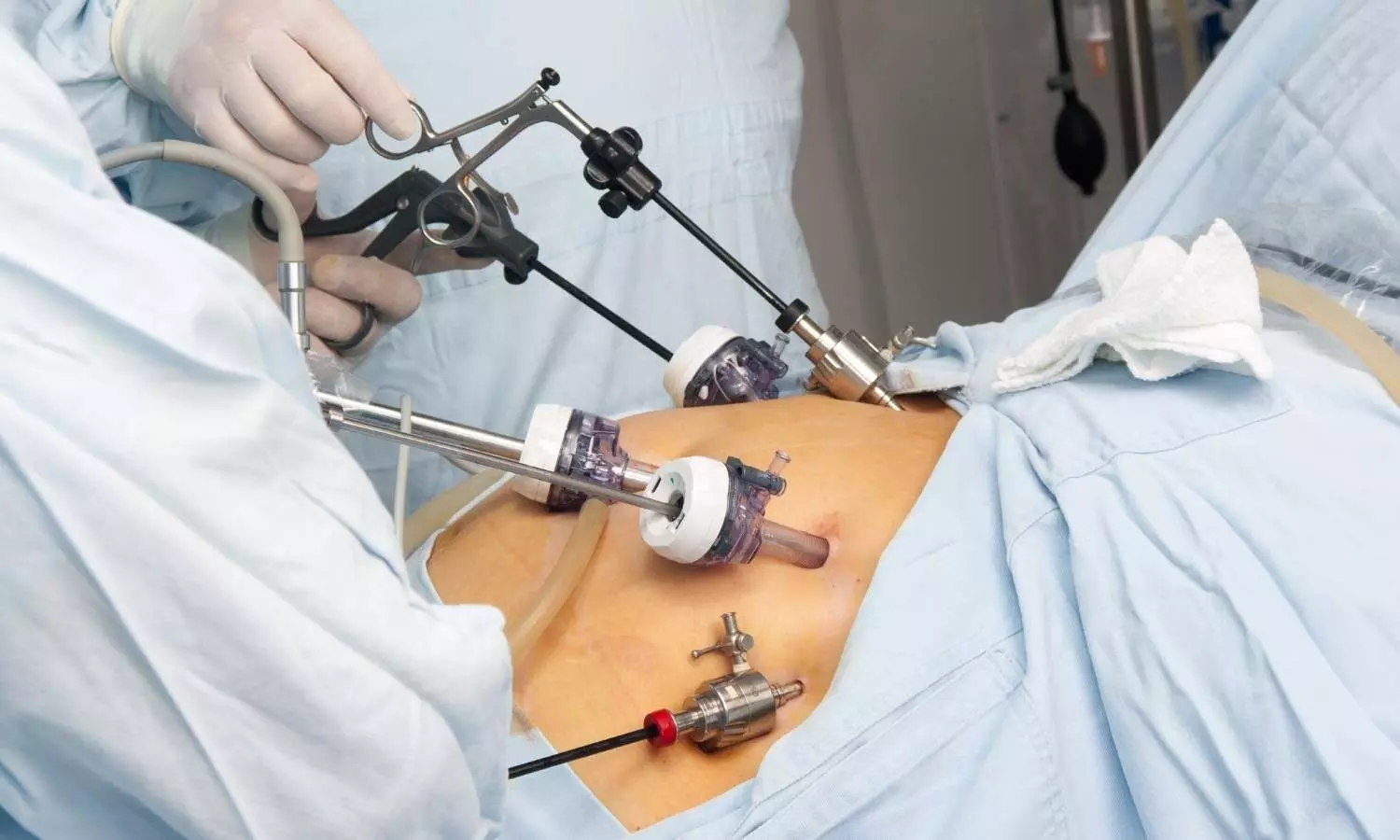 Performing open bypass surgery treatment of choice in chronic limb-threatening ischemia