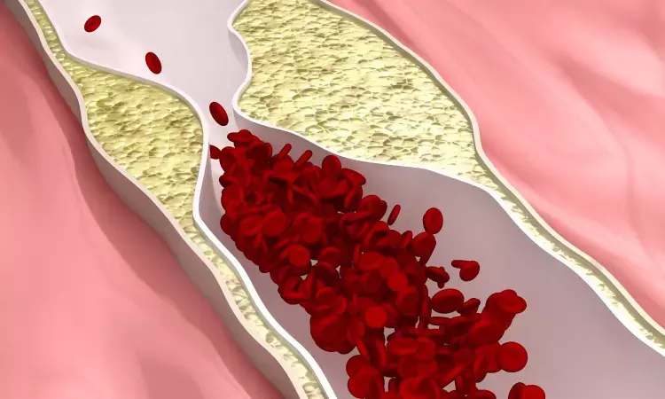 Restored blood flow meant less pain, better quality of life for those with leg artery disease