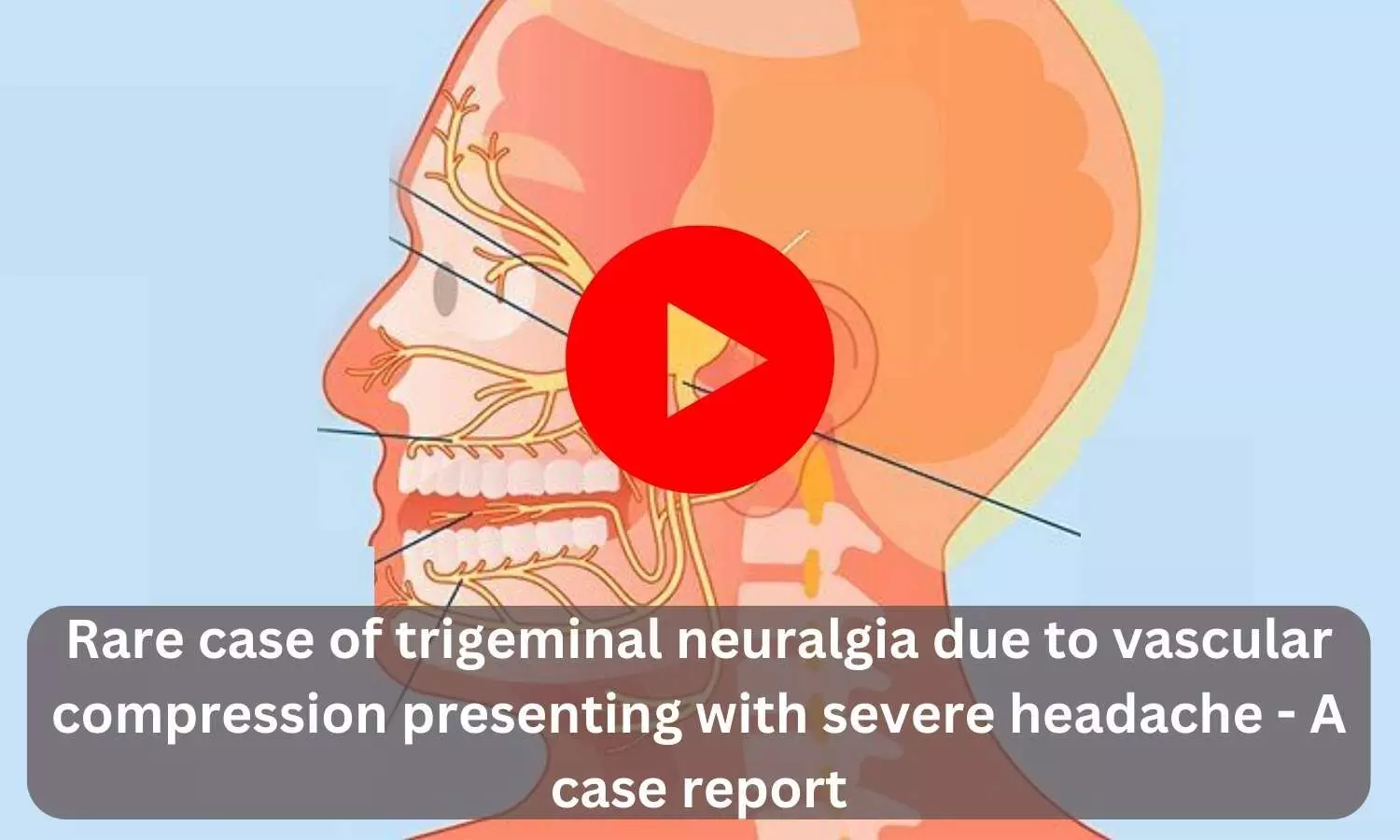 Rare case of trigeminal neuralgia due to vascular compression presenting with severe headache - A case report
