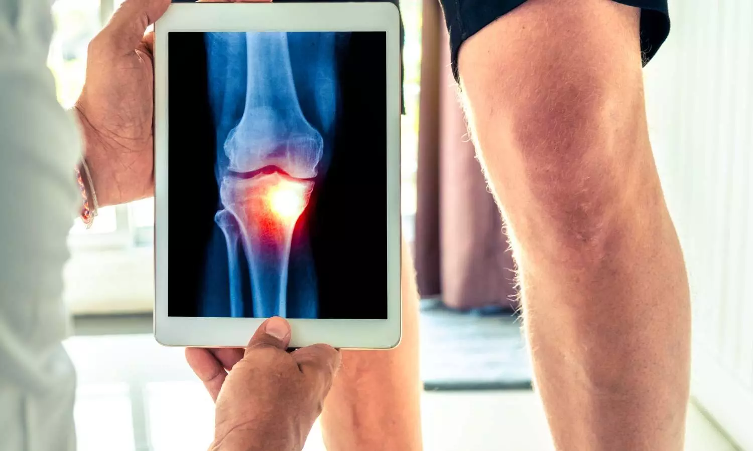 Genicular nerve block provides short-term pain relief in knee osteoarthritis: Study