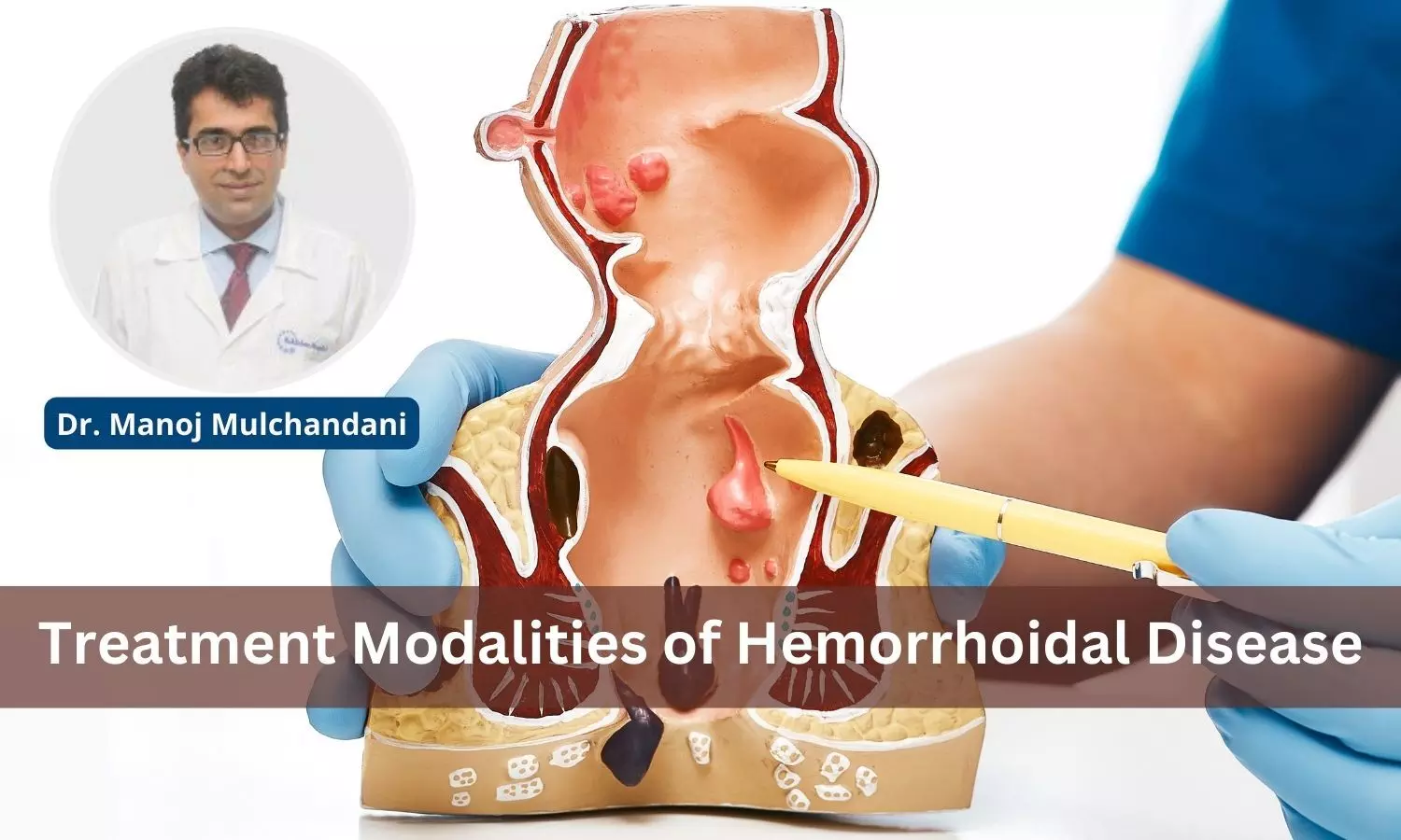 Treatment Modalities of Hemorrhoidal Disease