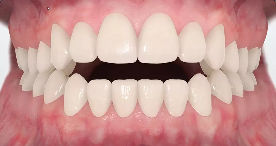 30-degree inclination for PDT best for anterior crossbite in deciduous dentition