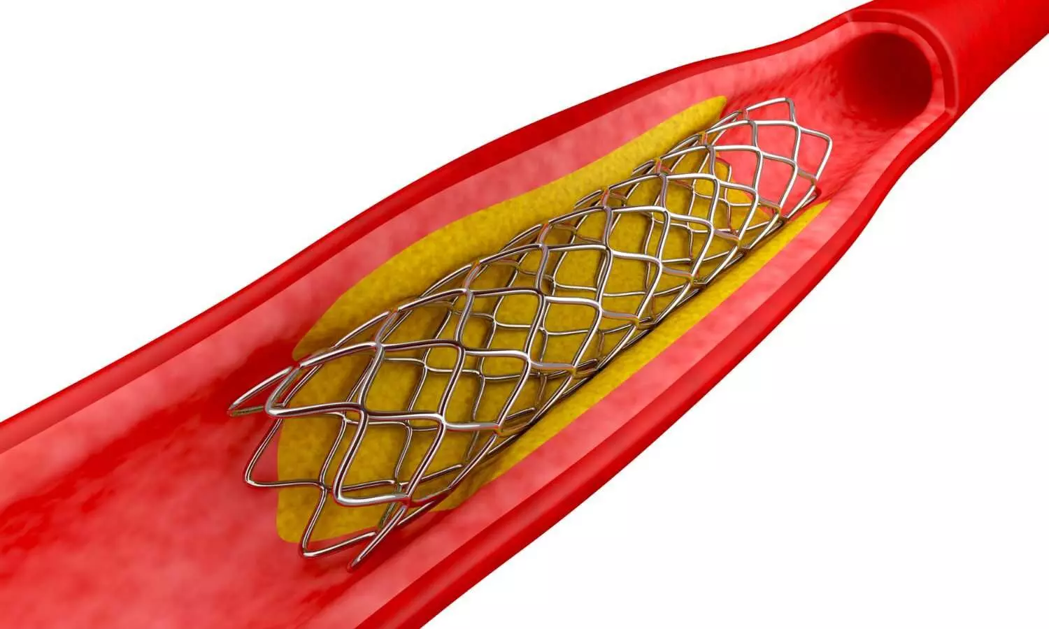 Coronary stents now included in NLEM 2022