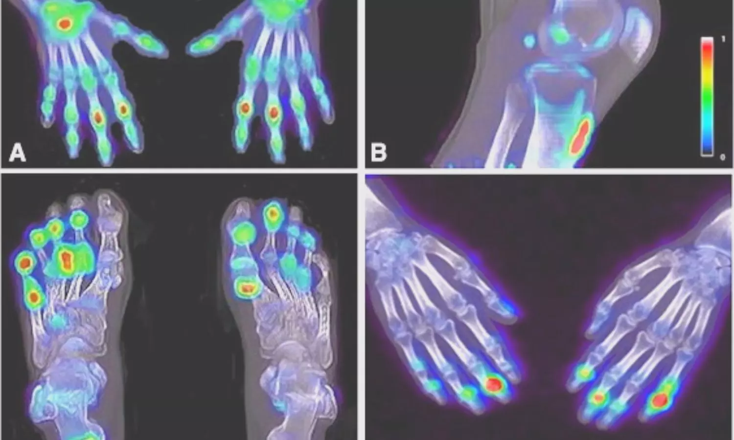 18F-sodium fluoride PET-CT visualizes bone formation in psoriatic arthritis patients: Study