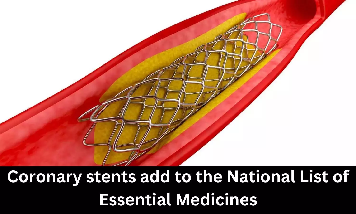Coronary stents added to NLEM 2022
