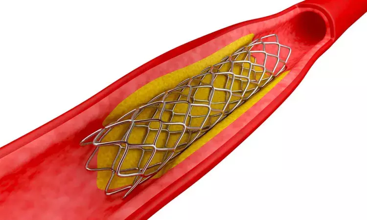 Paclitaxel-coated balloon and paclitaxel-eluting stent safe option for DES in-stent restenosis in PCI