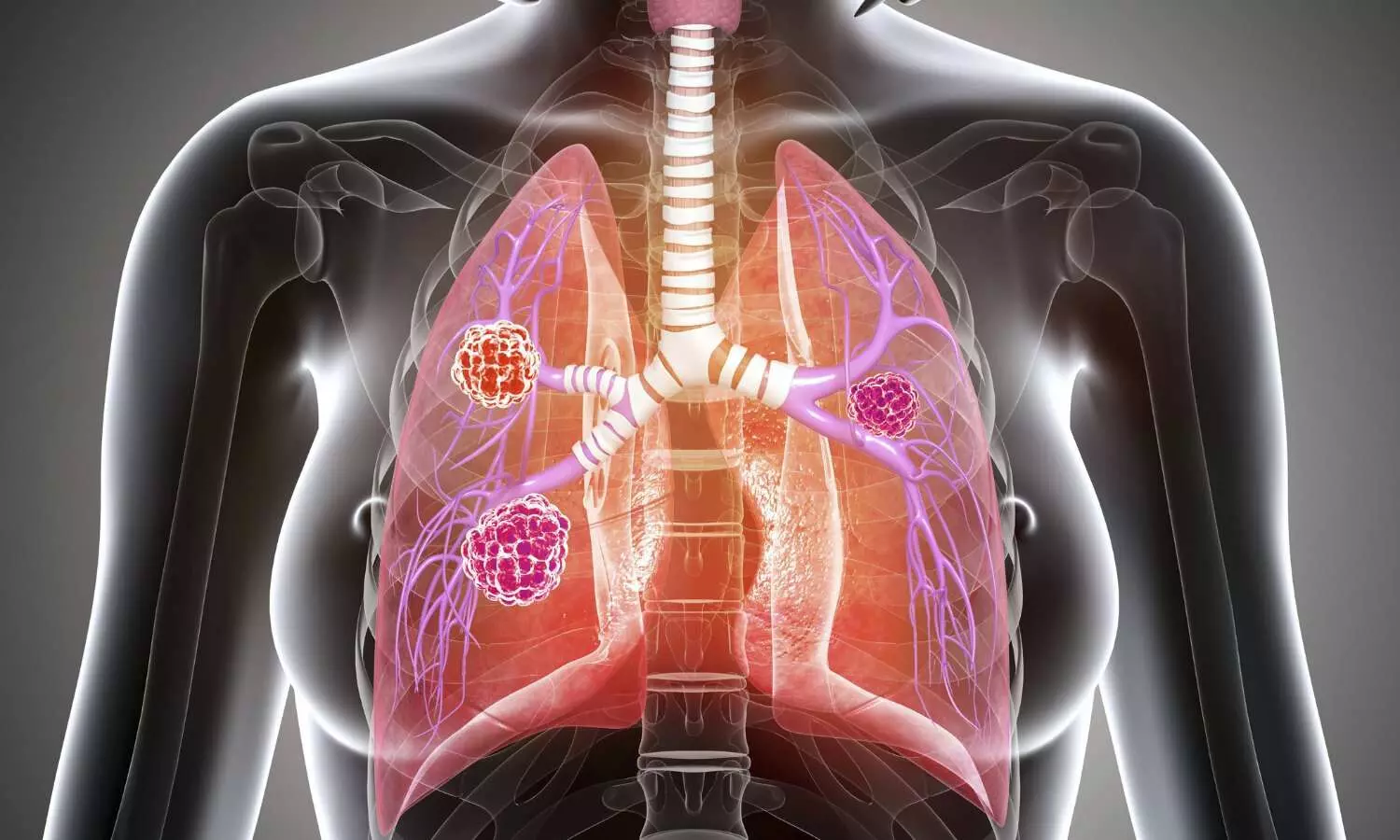 Lung cancer diagnosis at early stage via CT screening increases long-term survival rate