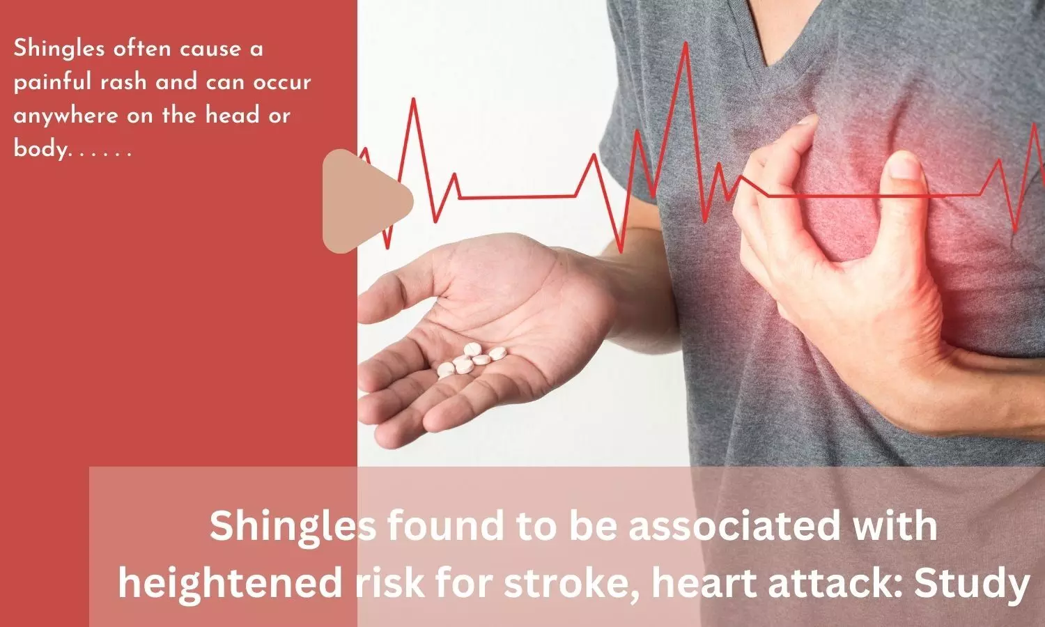 Shingles found to be associated with heightened risk for stroke, heart attack: Study