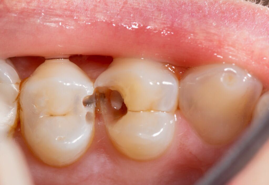 partial-pulpotomy-better-in-terms-of-clinical-and-radiographic