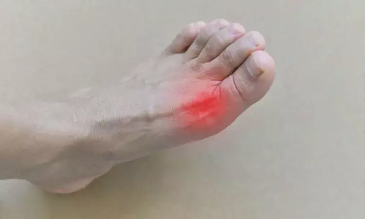 Gout under reported finding in patients of peritoneal and hemodialysis