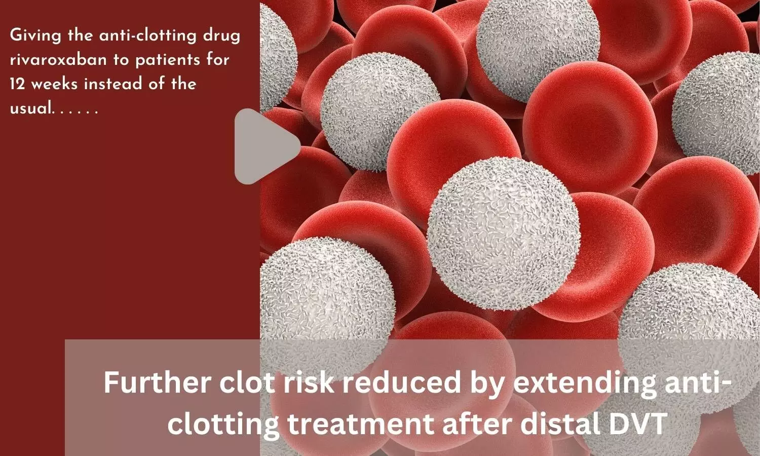 Further clot risk reduced by extending anti-clotting treatment after distal DVT