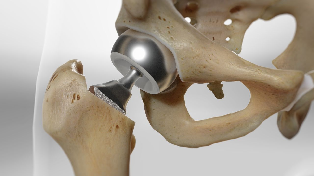 Preoperative LCR can predict mortality and complications in displaced ...