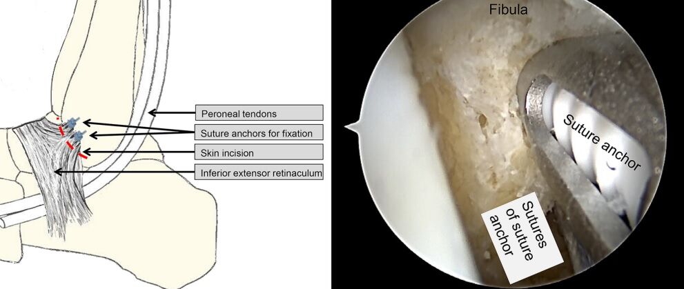 Arthroscopic Modified Brostrom Operation Allows Faster Recovery In Chronic Ankle Instability