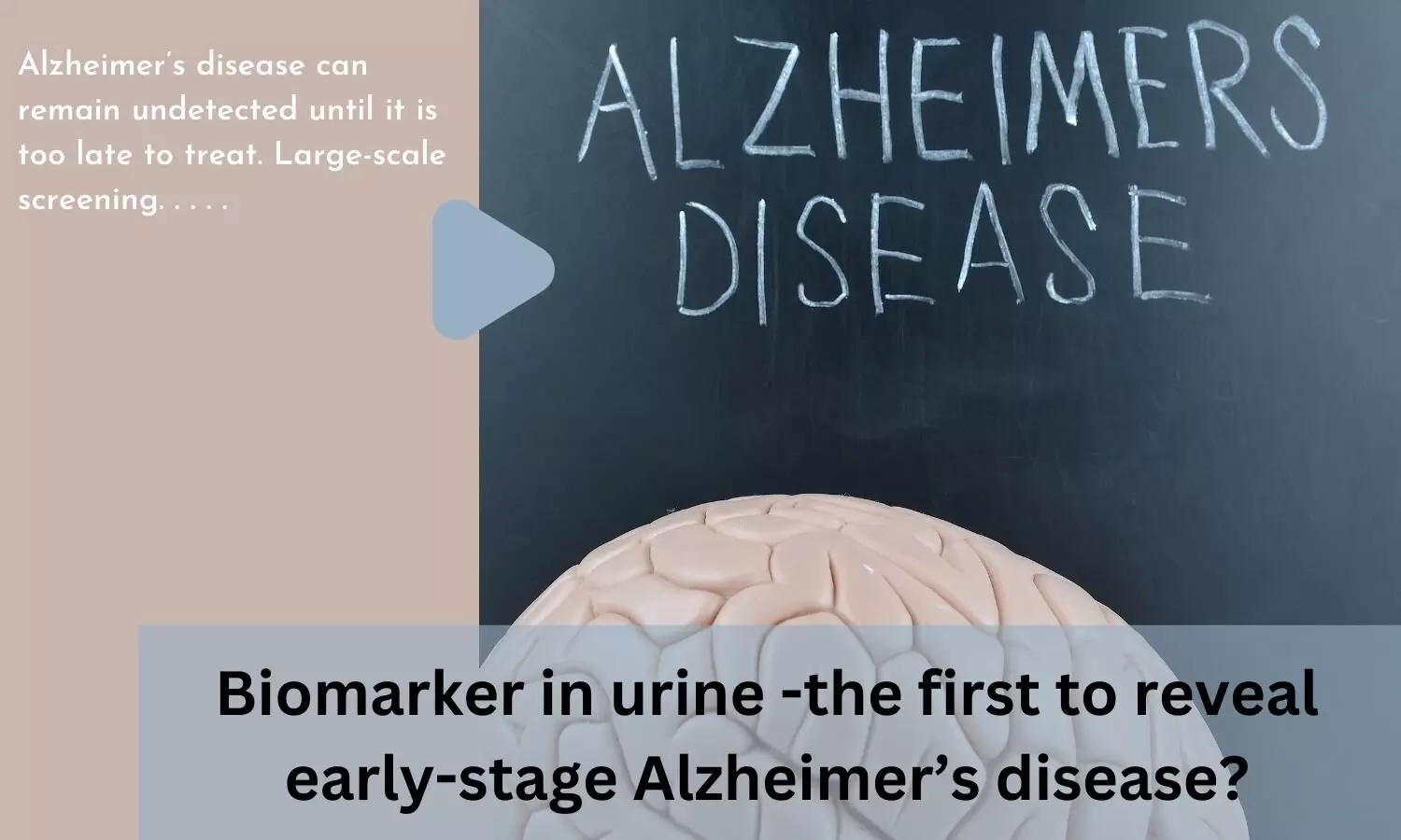 Biomarker in urine -the first to reveal early-stage Alzheimers disease?