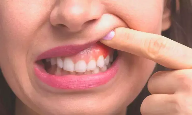 Study suggests association between periodontitis and increased blood uric acid levels