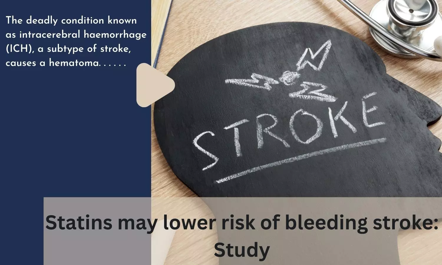 Statins may lower risk of bleeding stroke: Study