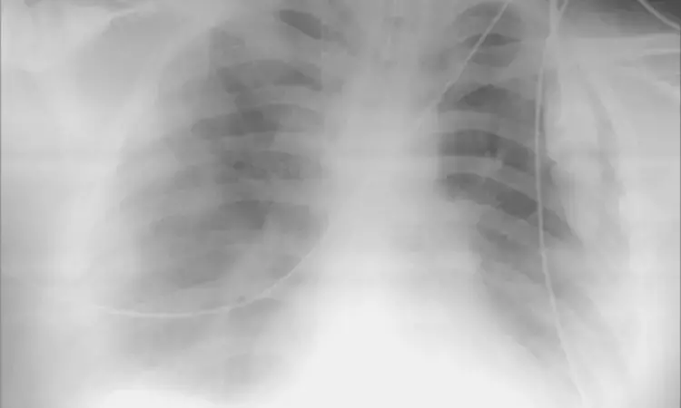 Chest x-ray has lower sensitivity for detecting thoracic injury in children exposed to blast