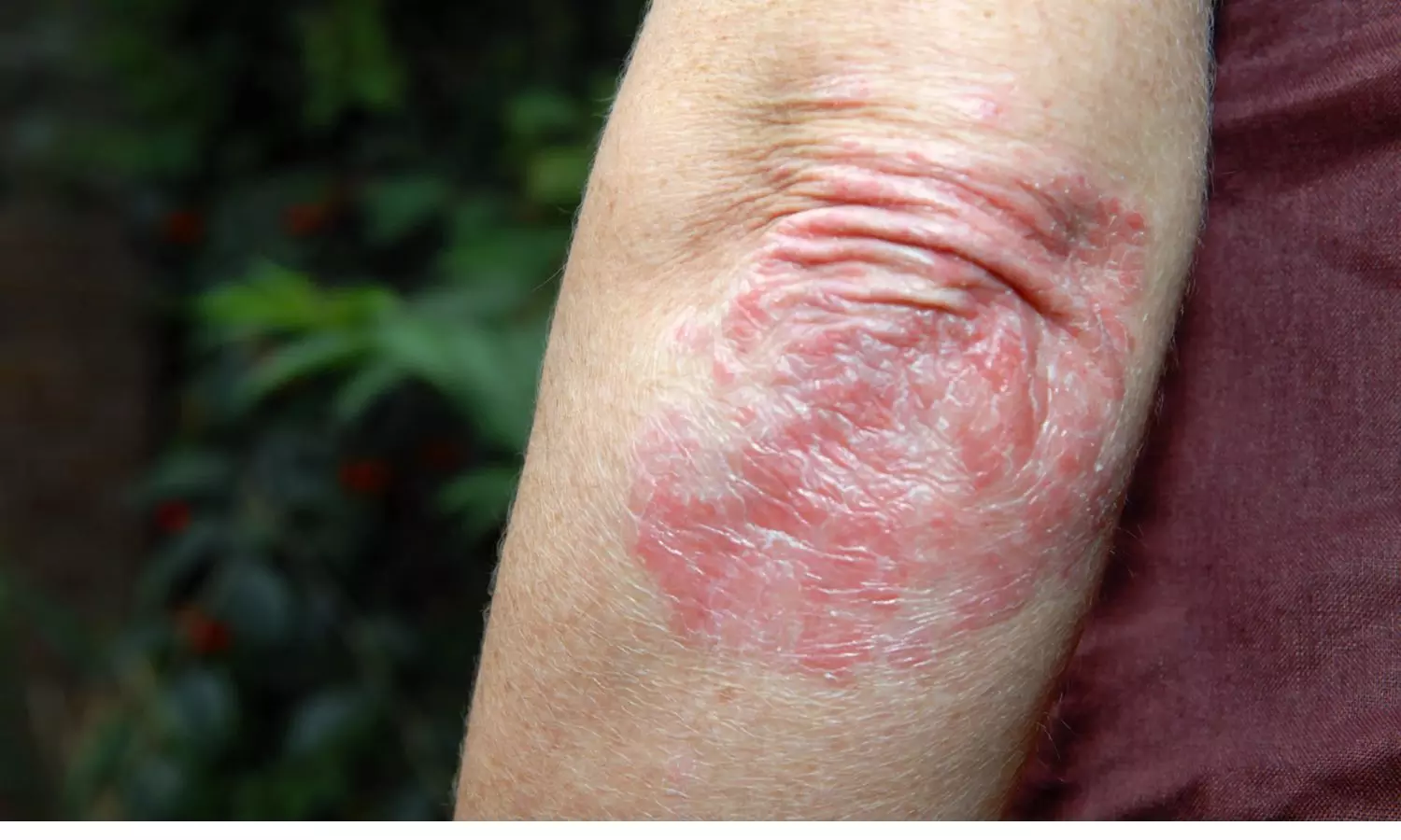 Mirikizumab efficacy to placebo for treating moderate-to-severe plaque psoriasis