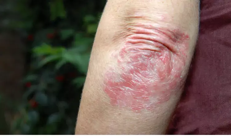 Oral IL-23 inhibitor promising for treatment of moderate-to-severe plaque psoriasis: NEJM