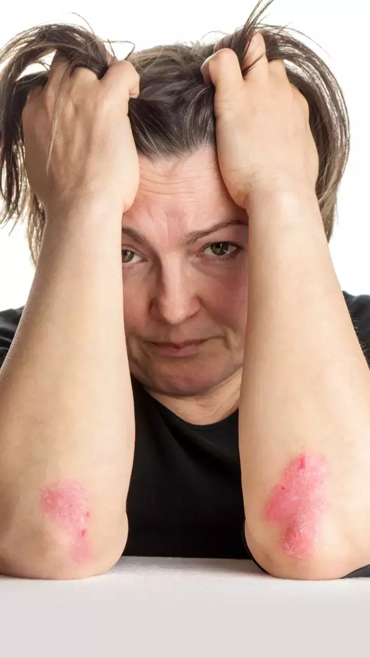 How to Manage Psoriasis in Winter