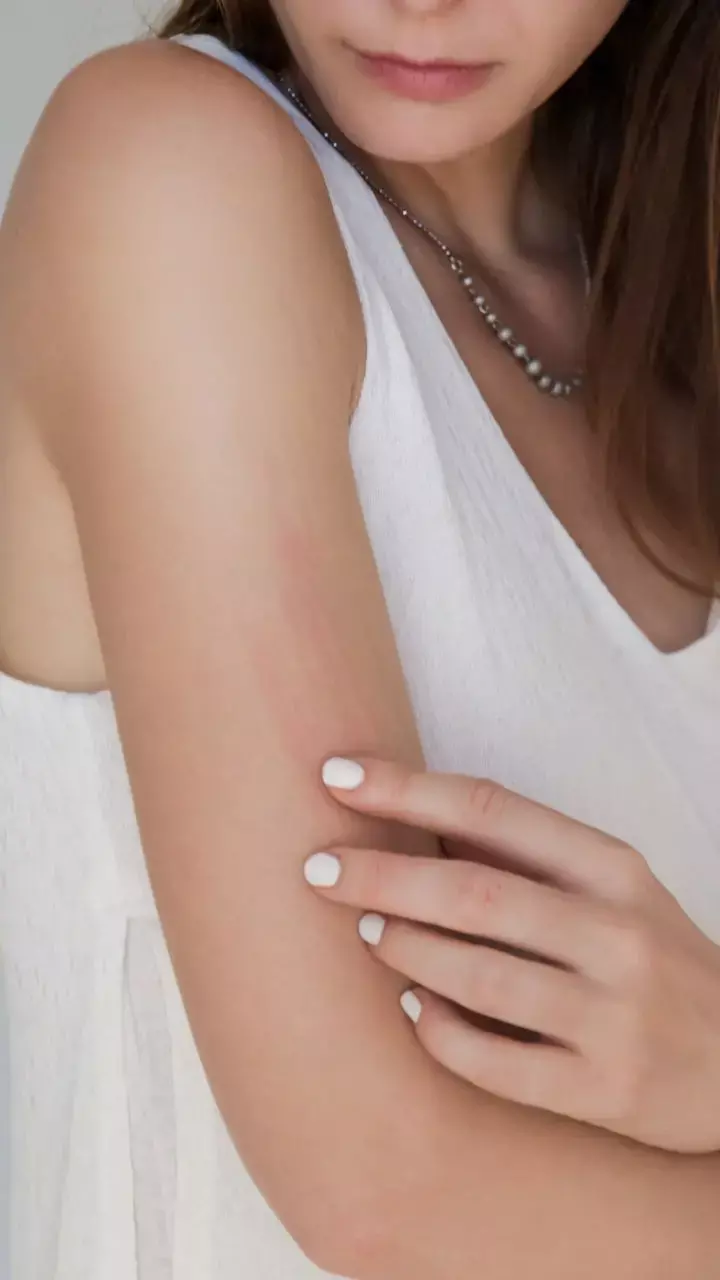 How to Manage Psoriasis in Winter