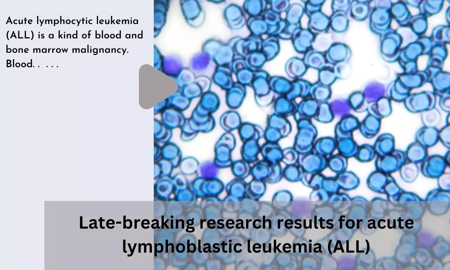Late-breaking research results for acute lymphoblastic leukemia (ALL)